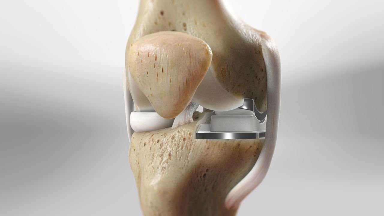 Partial knee replacement - Ajay Gour