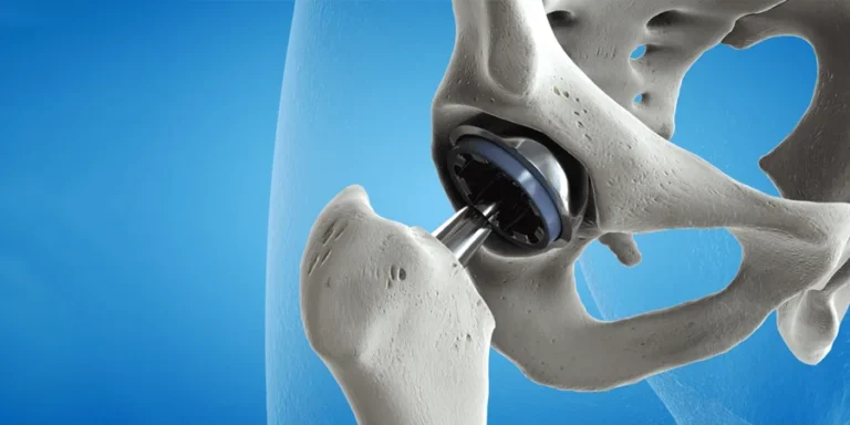 Hip-Replacement